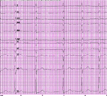 ECG 35