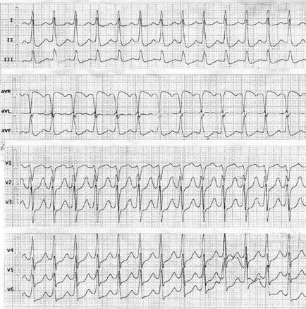 ECG 35