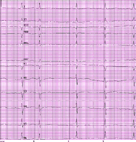 ECG 35