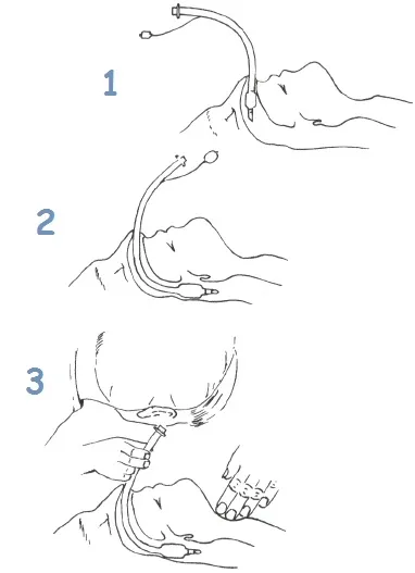 endotracheális intubálás