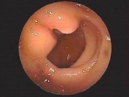 Enteroscopy опции, възможности, свидетелство