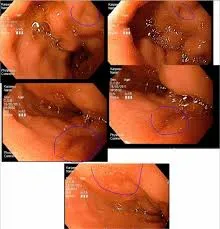 EGD стомаха, че показва