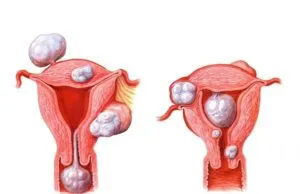 Fibrom si fibrom uterin care este diferenta