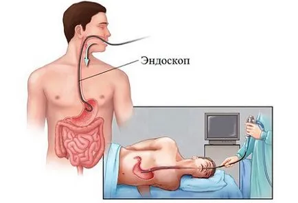 EGD vagy gasztroszkópia a gyomorban - amely azt mutatja,