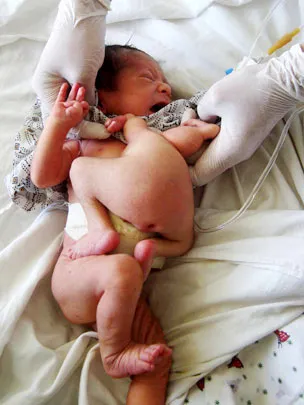 Fényképek a sziámi ikrek, a terhes és már slabonerv