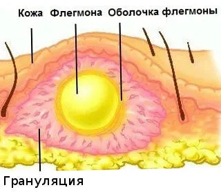 picior Celulită, degetele de la picioare, abces picior, tratamentul abceselor, abcese