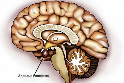 Галакторея рак на гърдата при жените и мъжете Какво има, причини, симптоми и лечение