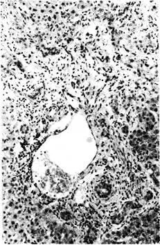 Хистологичните промени в черния дроб - studopediya