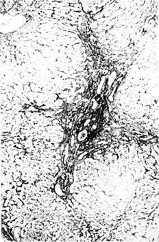Хистологичните промени в черния дроб - studopediya