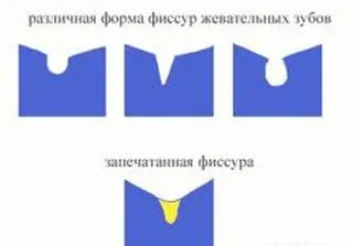 герметизація фісур
