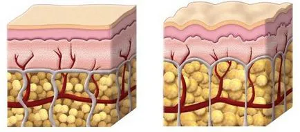 Gynoid lipodisztrófia okoz, a kezelés