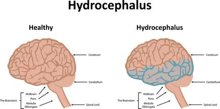 agy hydrocephalus felnőtteknél okoz, tünetei, kezelése