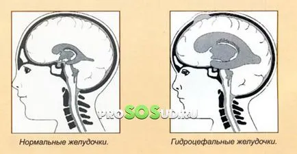 hidrocefalie creier (hidrocefalie) la adulți și copii