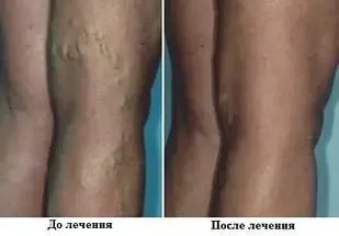 Уколи від варикозу вен на ногах - які роблять частіше за все, кращі з (частіше) Уколи від варикозу вен на ногах - які роблять частіше за все, кращі з