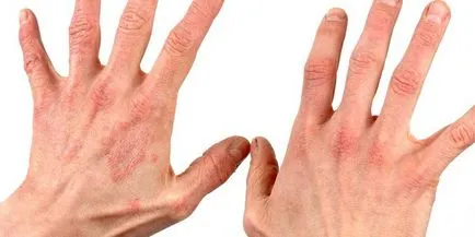 Gomba az ujjak között - az okok és a kezelés a betegség, ellentétben allergiák és más betegségek
