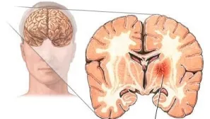 atacul cerebral hemoragic la copii și ischemică