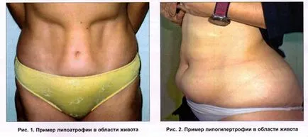 інсулінова липодистрофия