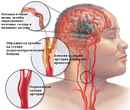 Stroke férfiak és a nők