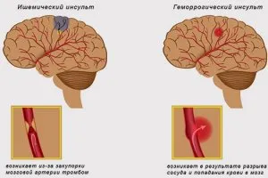 Исхемична симптоми и лечение инсулт, последствията и прогноза