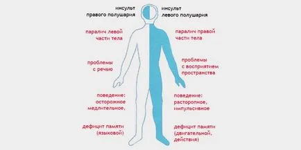 Исхемична симптоми и лечение инсулт, последствията и прогноза