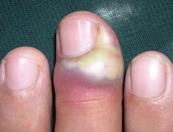 Din cauza a ceea ce se poate umfla un deget în apropiere de unghii, cresteri ale pielii