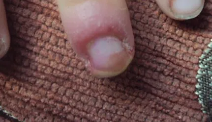 Din cauza a ceea ce se poate umfla un deget în apropiere de unghii, cresteri ale pielii