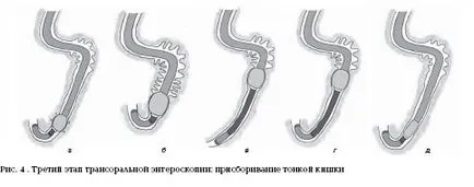 Какъв по-добър enteroscopy - odnobalonnaya или двойна балон