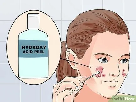 Cum de a elimina rapid urmele de acnee
