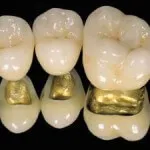Mi koronát a fogakon választani