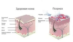 Какви са усложненията на псориазис причините и последствията от липсата на лечение