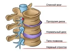Вправи при протрузії поперекового відділу хребта (допомога хребту) Вправи при протрузії поперекового відділу хребта
