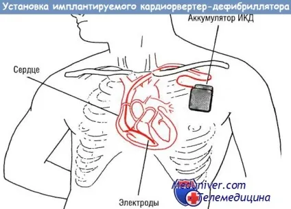 Установка имплантируемого кардіовертера-дефібрилятора (ІКД) (імплантується) Установка имплантируемого кардіовертера-дефібрилятора (ІКД)