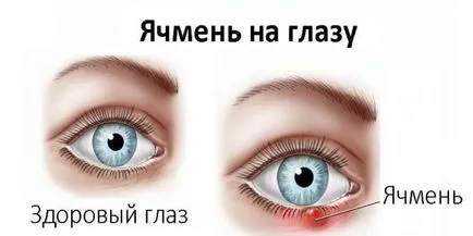 Як лікувати ячмінь на оці в домашніх умовах