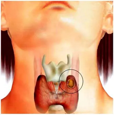 Cum de a trata un chist tiroidian cauze, simptome si tratament de chisturi ale glandei tiroide