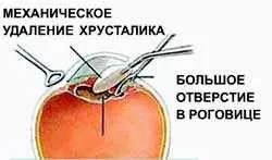 Какво е най-добрият обектив за катаракта изкуствена леща Избор на възстановяване