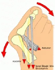 Вальгусна деформація великого пальця (hallux valgus) (деформація) Вальгусна деформація великого пальця (hallux valgus)
