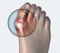 Вальгусна деформація великого пальця (hallux valgus) (деформація) Вальгусна деформація великого пальця (hallux valgus)