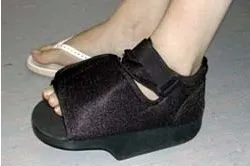 Вальгусна деформація великого пальця (hallux valgus) (деформація) Вальгусна деформація великого пальця (hallux valgus)