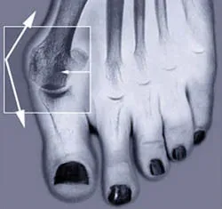 Вальгусна деформація великого пальця (hallux valgus) (великого) Вальгусна деформація великого пальця (hallux valgus)