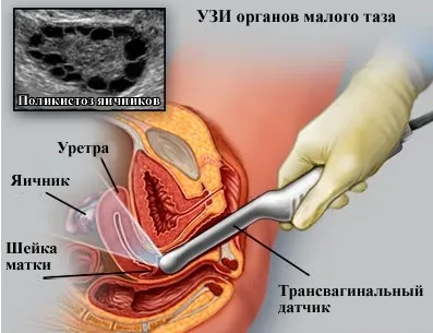 узі матки
