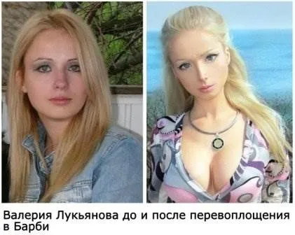 Валерія лукьянова фото до і після пластики (валерія) Валерія лукьянова фото до і після пластики