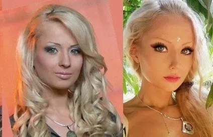 Валерія лукьянова фото до і після пластики (фото) Валерія лукьянова фото до і після пластики