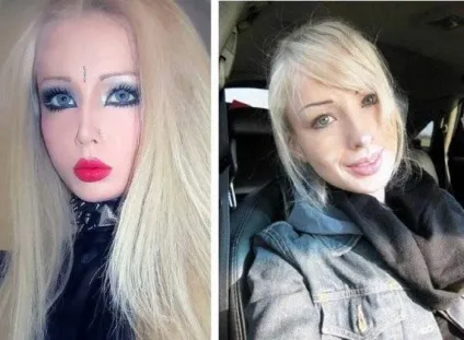 Валерія лукьянова фото до і після пластики (пластики) Валерія лукьянова фото до і після пластики