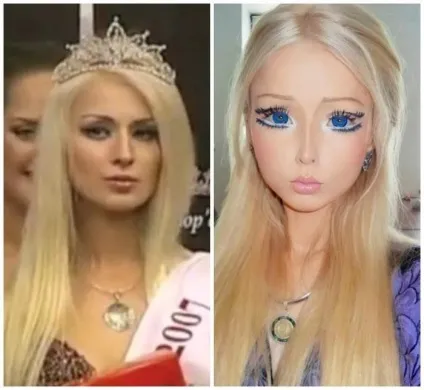 Валерія лукьянова фото до і після пластики (одеська барбі) Валерія лукьянова фото до і після пластики