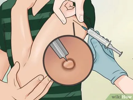 Hogyan kell szedni a cefalexin