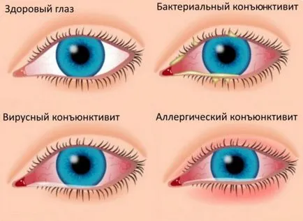 Как да премахнете зачервяване на окото капки от изтощение, мазила против възпаление, дразнене