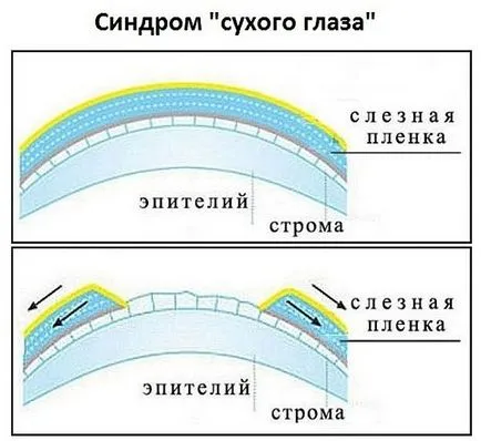 Cum de a elimina inrosirea ochiului scade de la epuizare, unguente împotriva inflamației, iritație