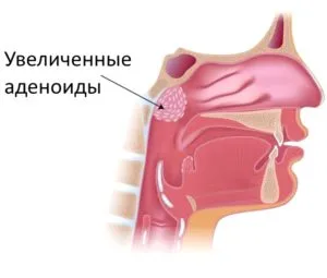 Ar fi polipii îndepărtat cu laser chirurgie pentru copii, fără anestezie