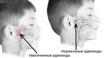 Както аденоиди отделят децата лазерна операция, без упойка