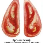 Види нежиті (риніту) їх симптоми і лікування (види) Види нежиті (риніту) їх симптоми і лікування